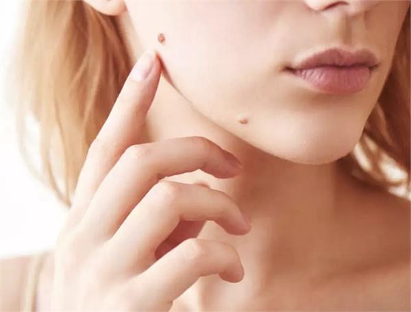 बिना सर्जरी के पाएं तिल से छुटकारा