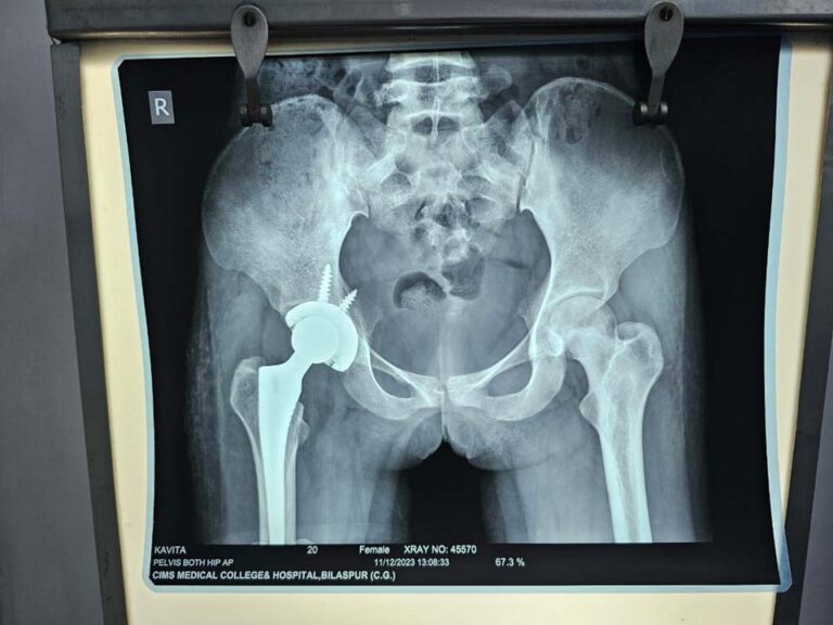 सिम्स में गरीब किसान की बेटी का सफल टोटल हिप रिप्लेसमेंट ऑपरेशन