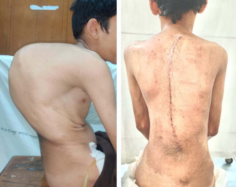 डॉ. धीरज सोनावणे ने की चुनौतीपूर्ण “स्पाइन सर्जरी”