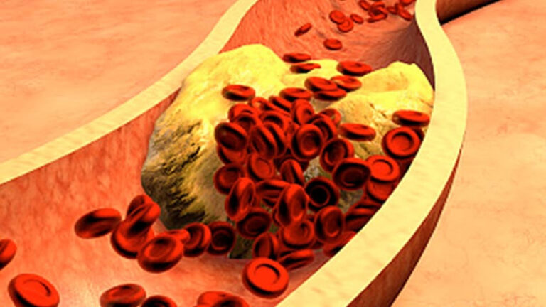 अति बढ़ गया है शरीर में कोलेस्ट्रॉल लेवल, तो कुछ दिनों तक करें सिर्फ ये काम, कोलेस्ट्रॉल पिघलकर खुल जाएंगी सारी नसें